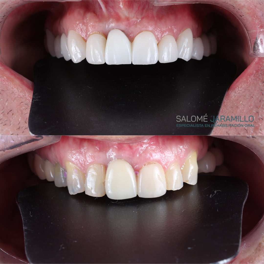 PACIENTE_CARLOS_GORRI_ANTES Y DESPUES ARCO SUPERIOR_1